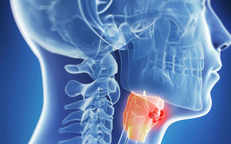 Первичная профилактика опухолей головы и шеи