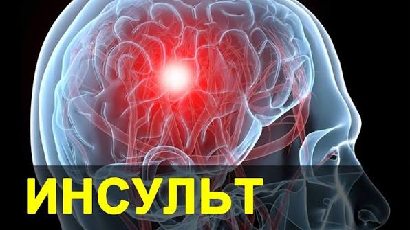 Как избежать инсульт???